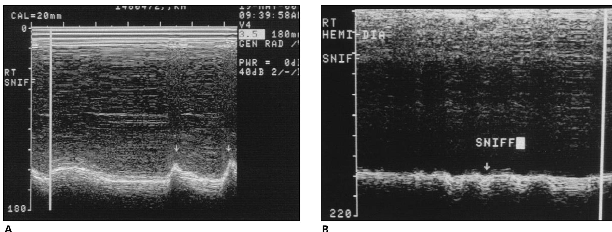 (PDF) Ultrasonographic evaluation of diaphragmatic motion