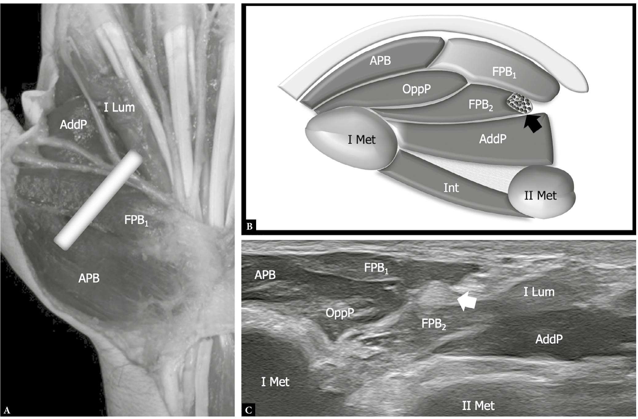 (PDF) Ultrasound of the palmar aspect of the hand: normal anatomy and ...