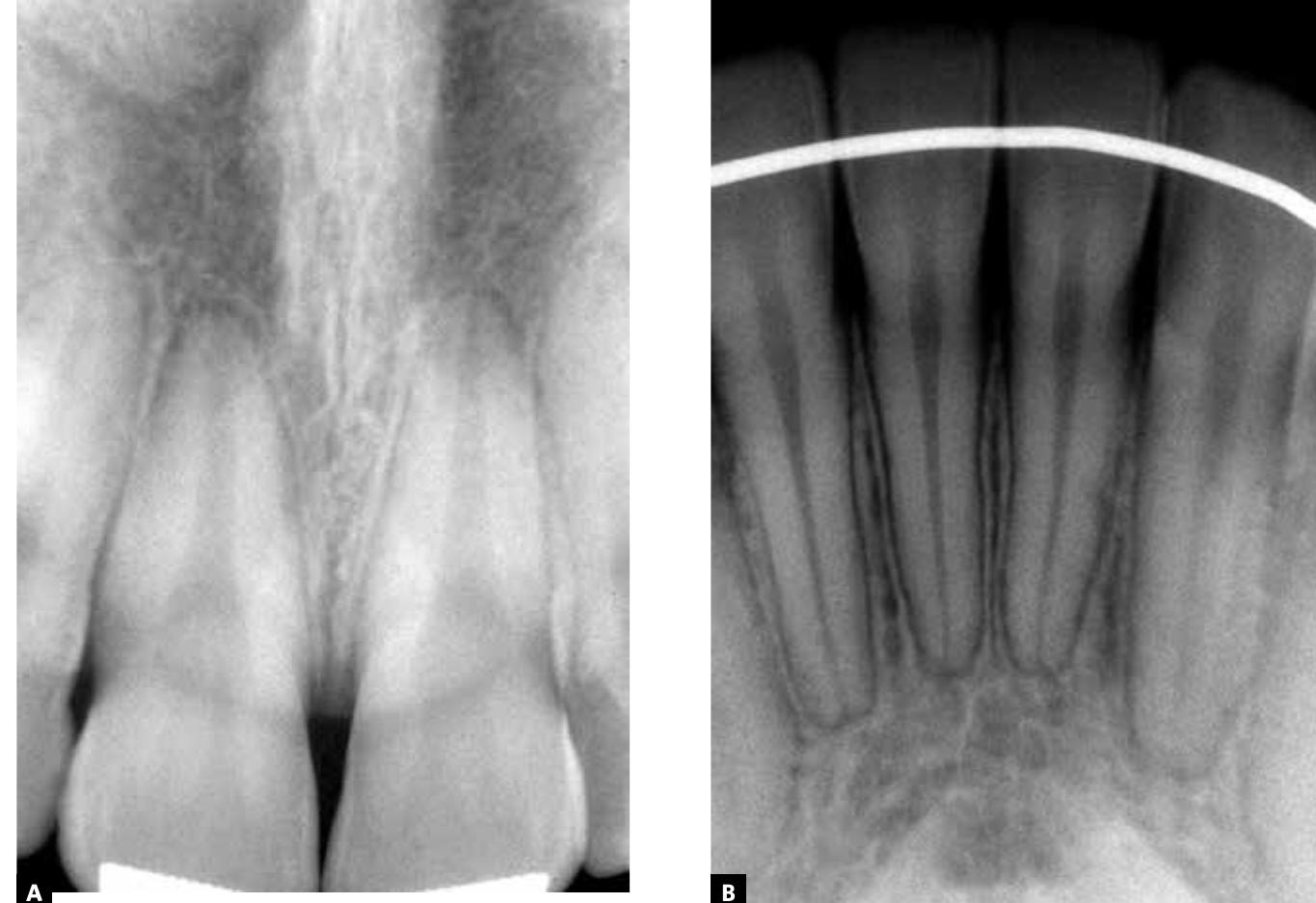 Figure 6 - from Class II malocclusion with deep overbite: a