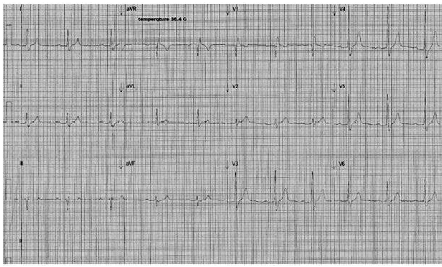 (PDF) Brugada Syndrome Type 1 Electrocardiogram Pattern Induced by ...