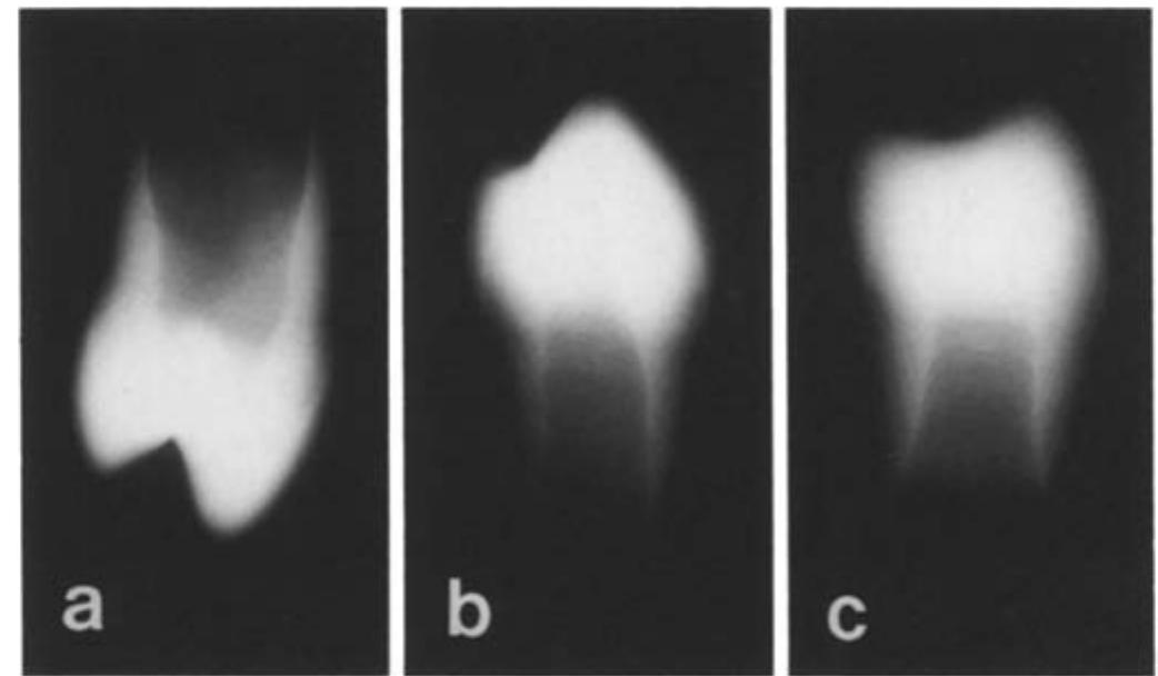 La~c. examples of x-ray photographs of a maxillary first