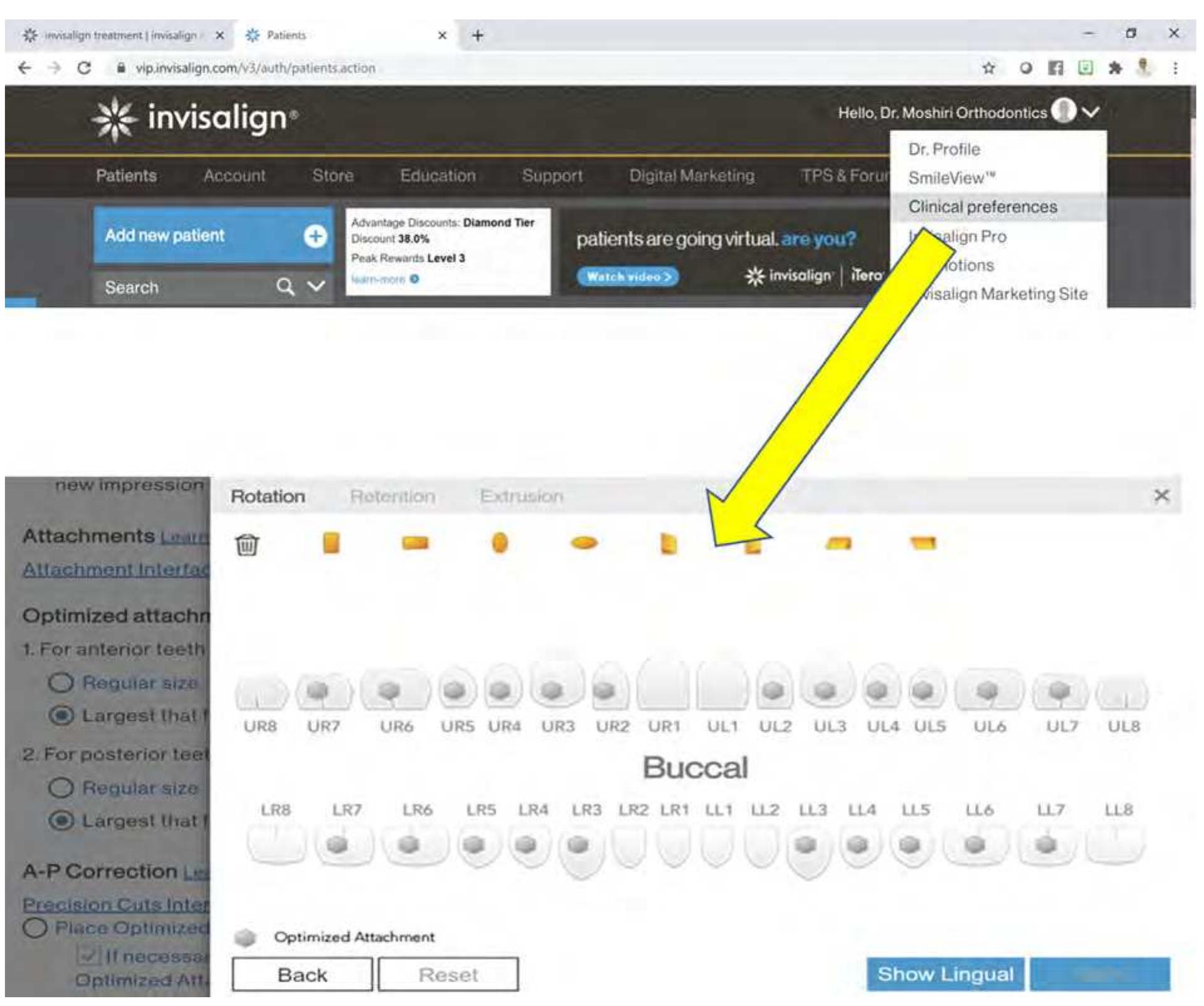 (PDF) Product review and demonstration of the Invisalign clear aligner ...
