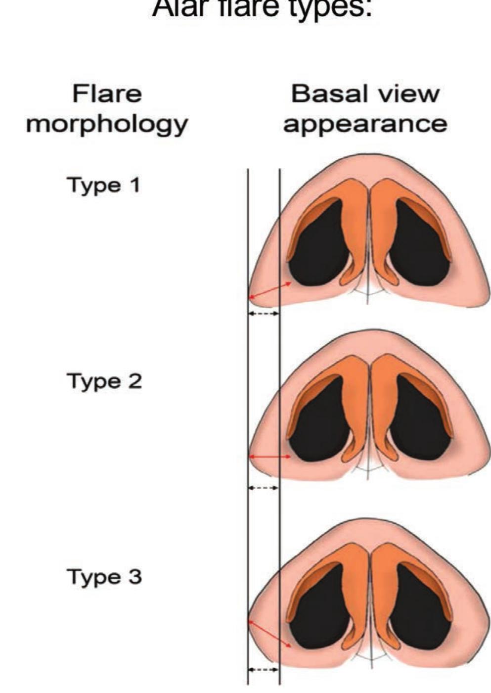 (PDF) Systematic Surgical Approach to Alar Base Surgery in Rhinoplasty