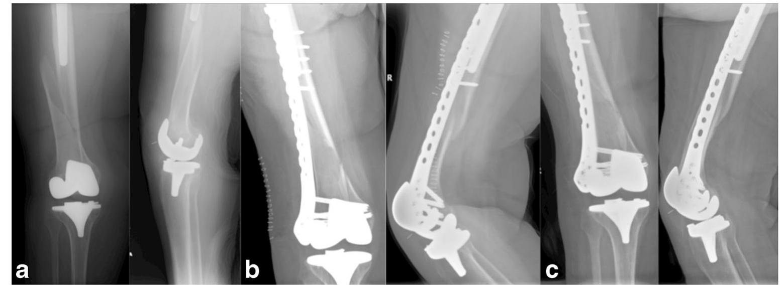 Figure 2 - from 2011 JT Treatment of Interprosthetic