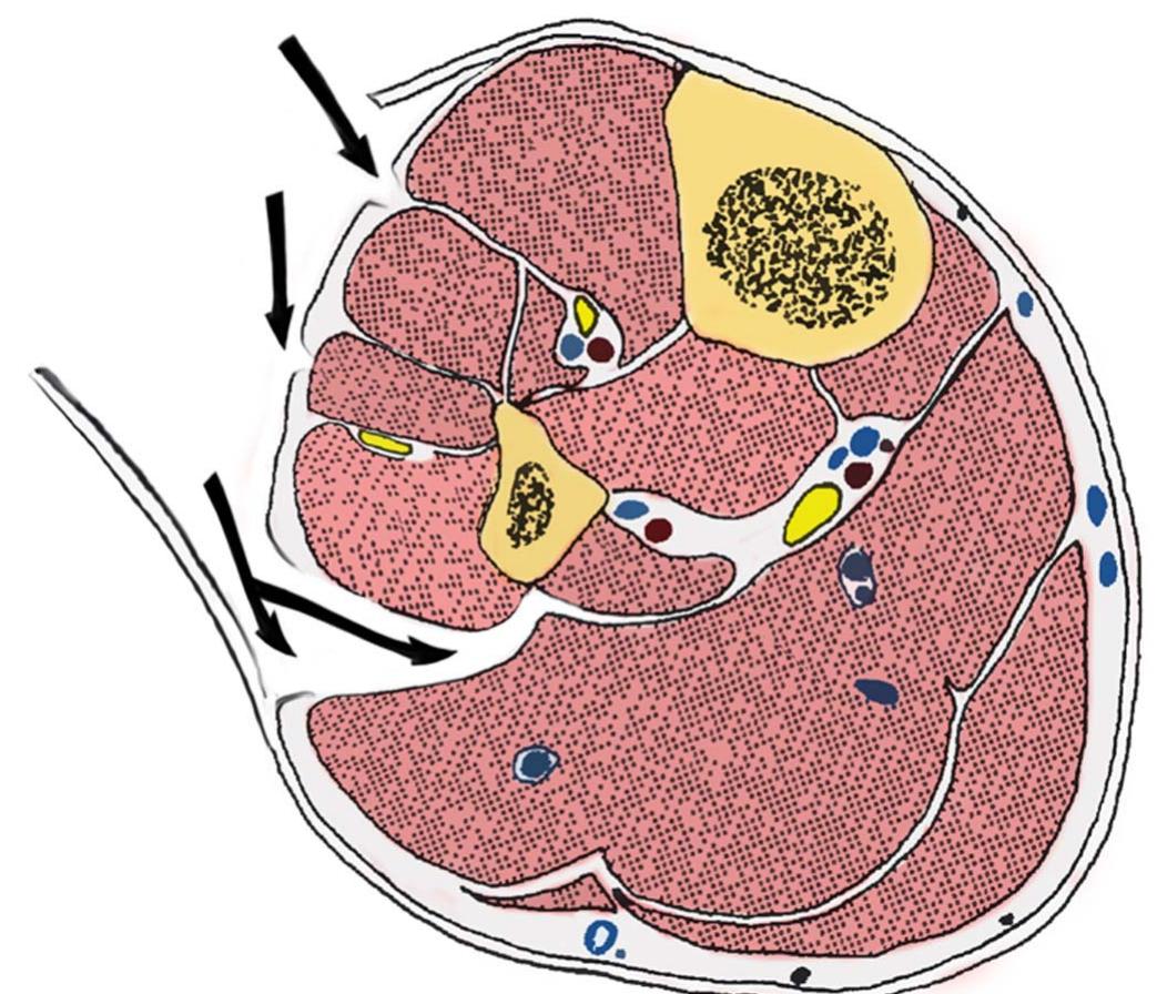 A schematic of the single incision fasciotomy as described