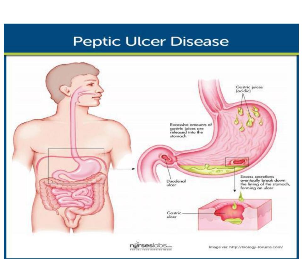 (PDF) Peptic Ulcer: A review