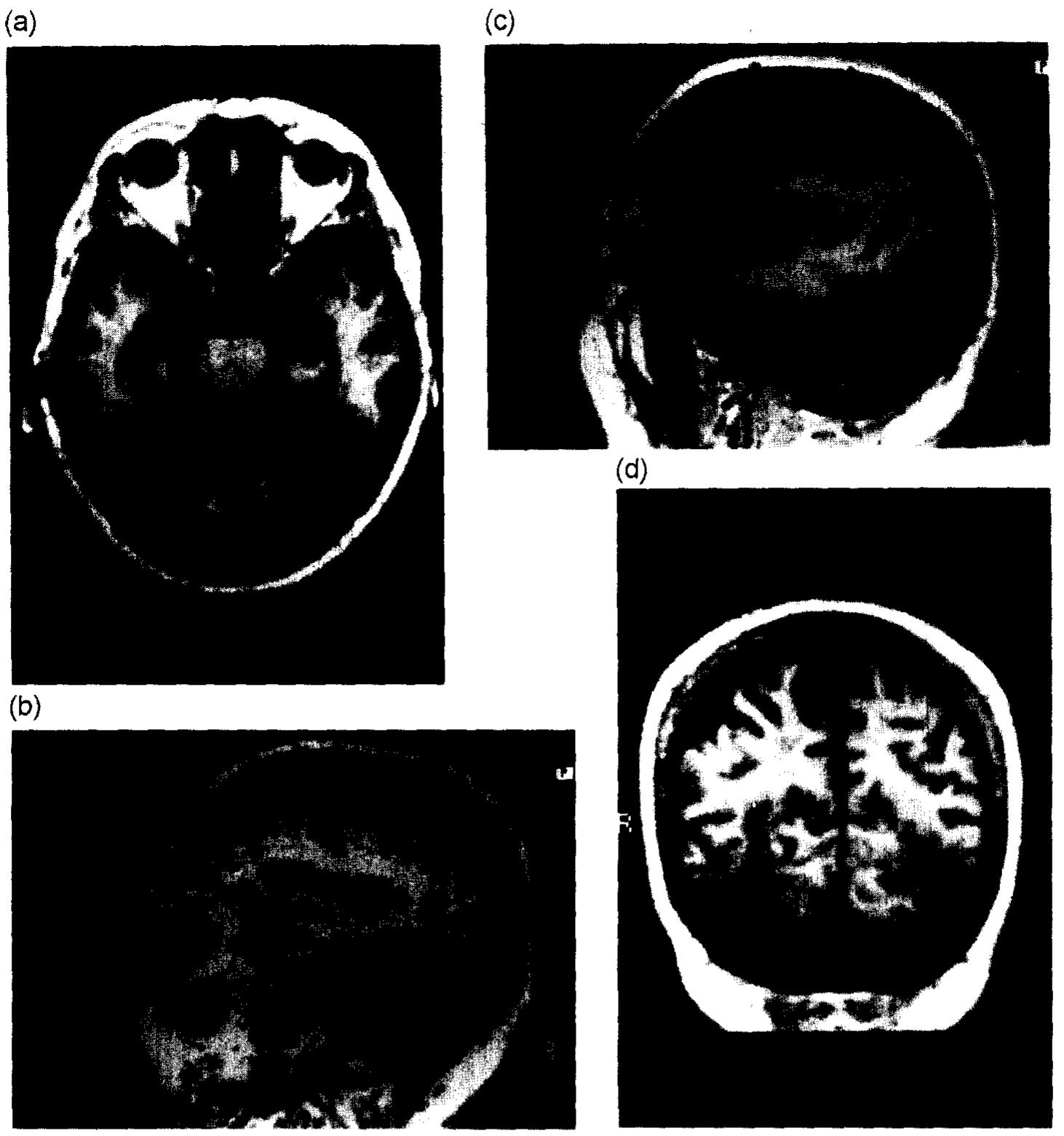 Ft Mri Scan Ig. 1. tl-weighted mri scan showing symmetric lesions in