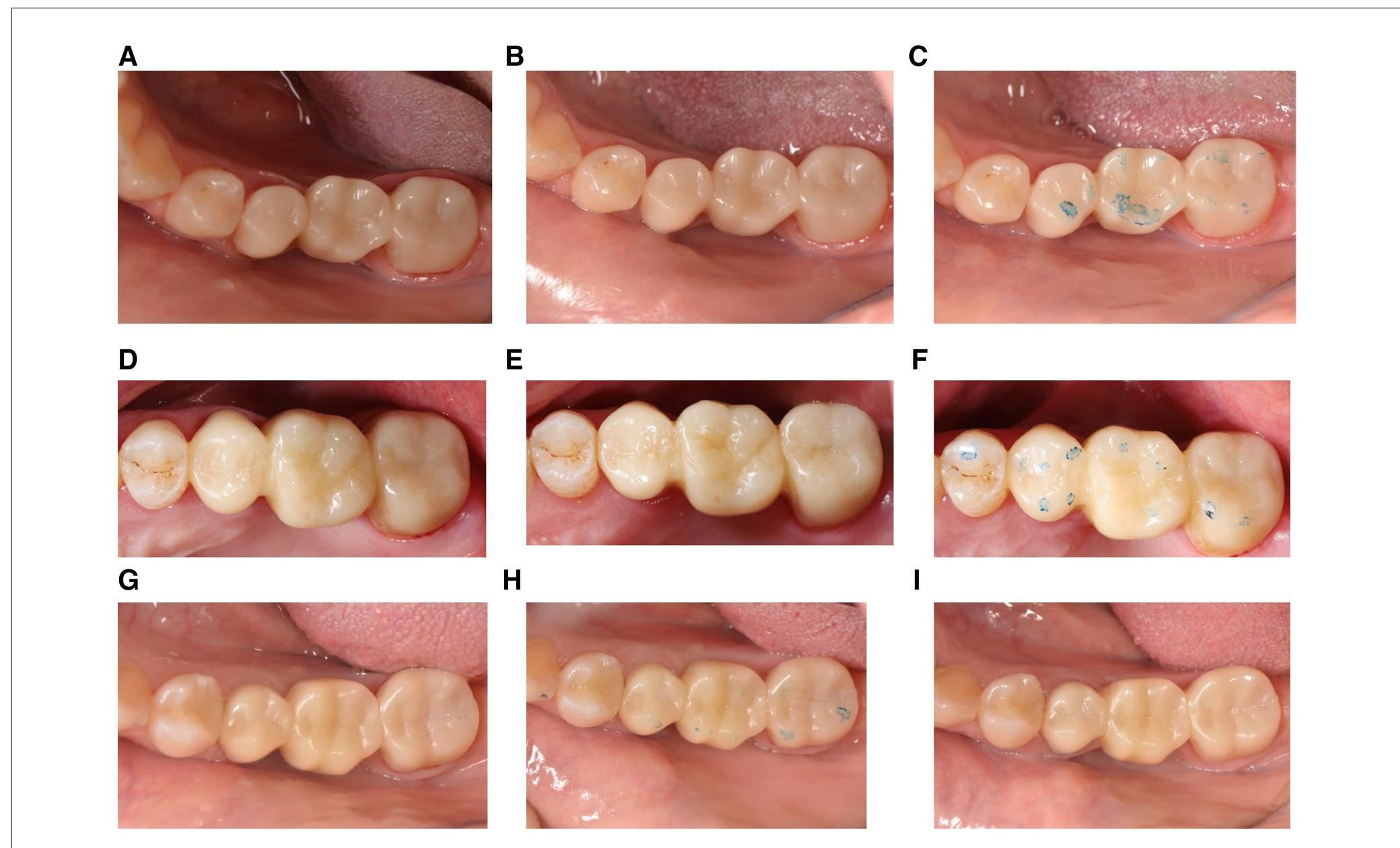 (PDF) 3D-printed resin composite posterior fixed dental prosthesis: a ...