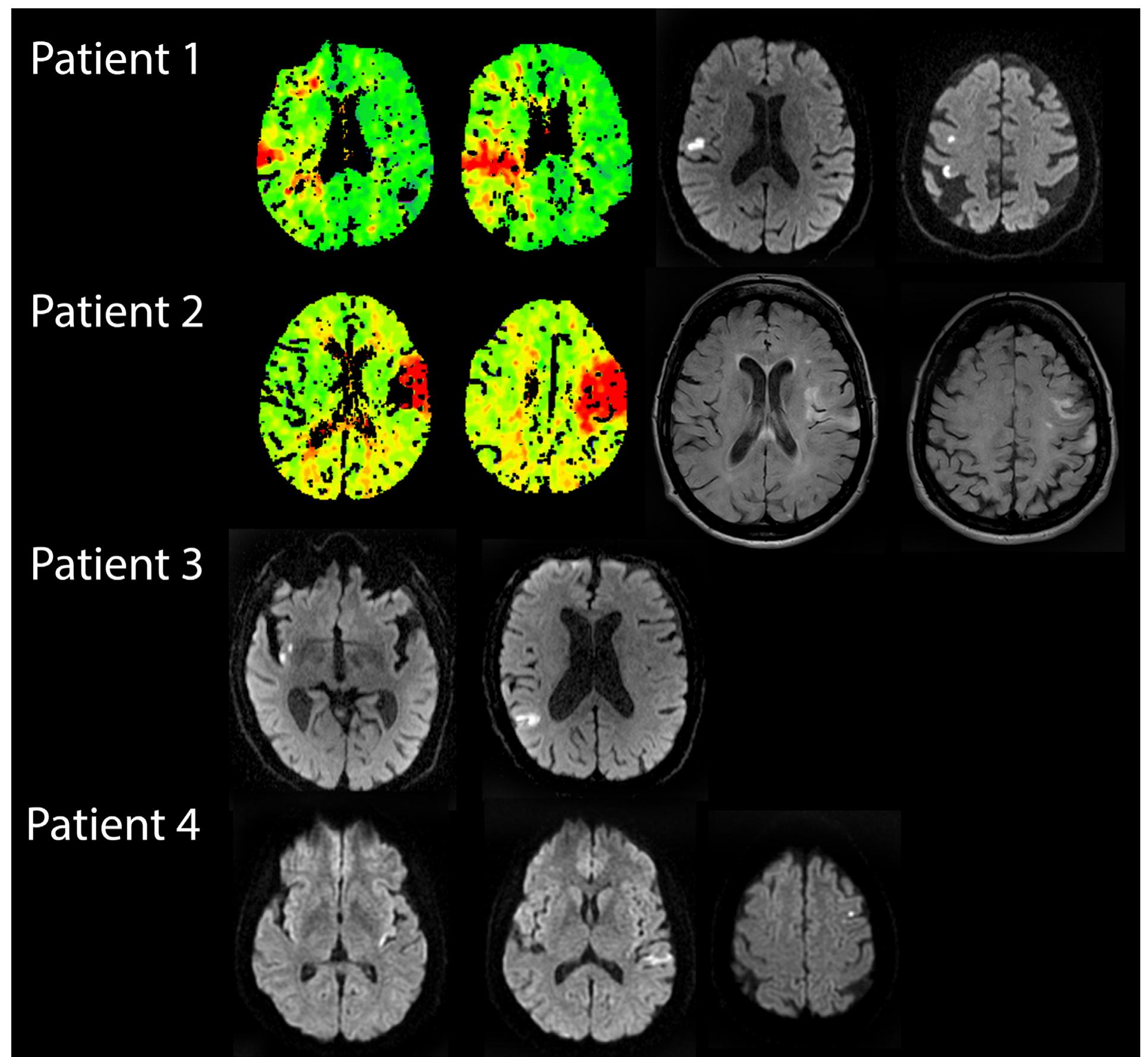 (PDF) Hemichorea as Presentation of Acute Cortical Ischemic Stroke ...