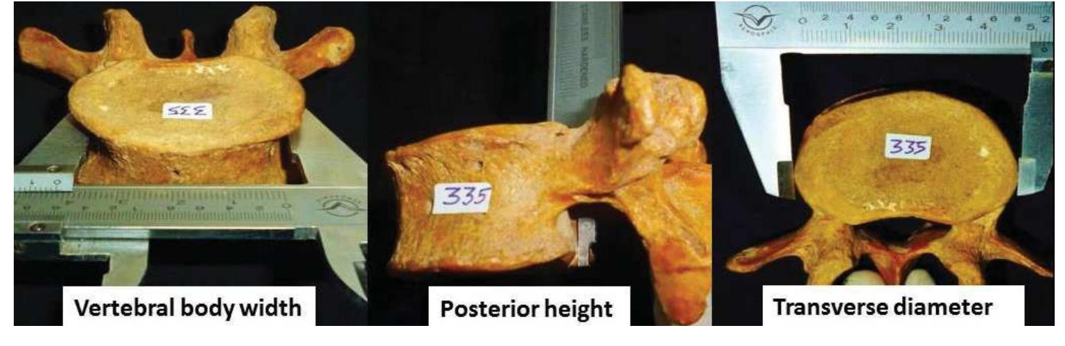 (PDF) A Morphometric Study of the Vertebral Body in Dry Human Typical ...