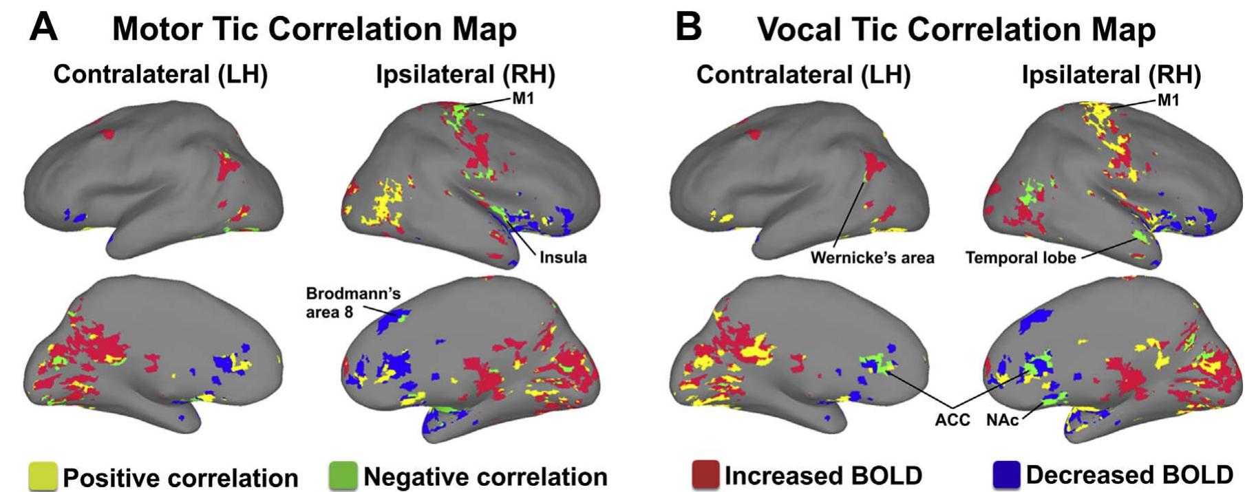 Tic Positive Motor and vocal tic reduction by different circuit effects.