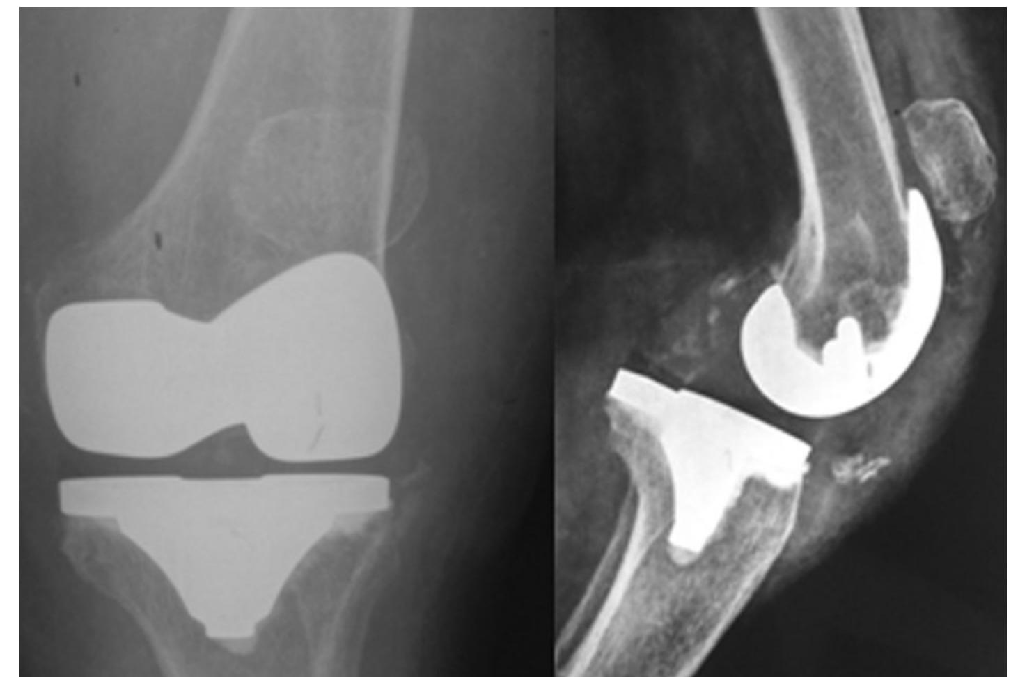 (PDF) How to Interpret Postoperative X-rays after Total Knee Arthroplasty