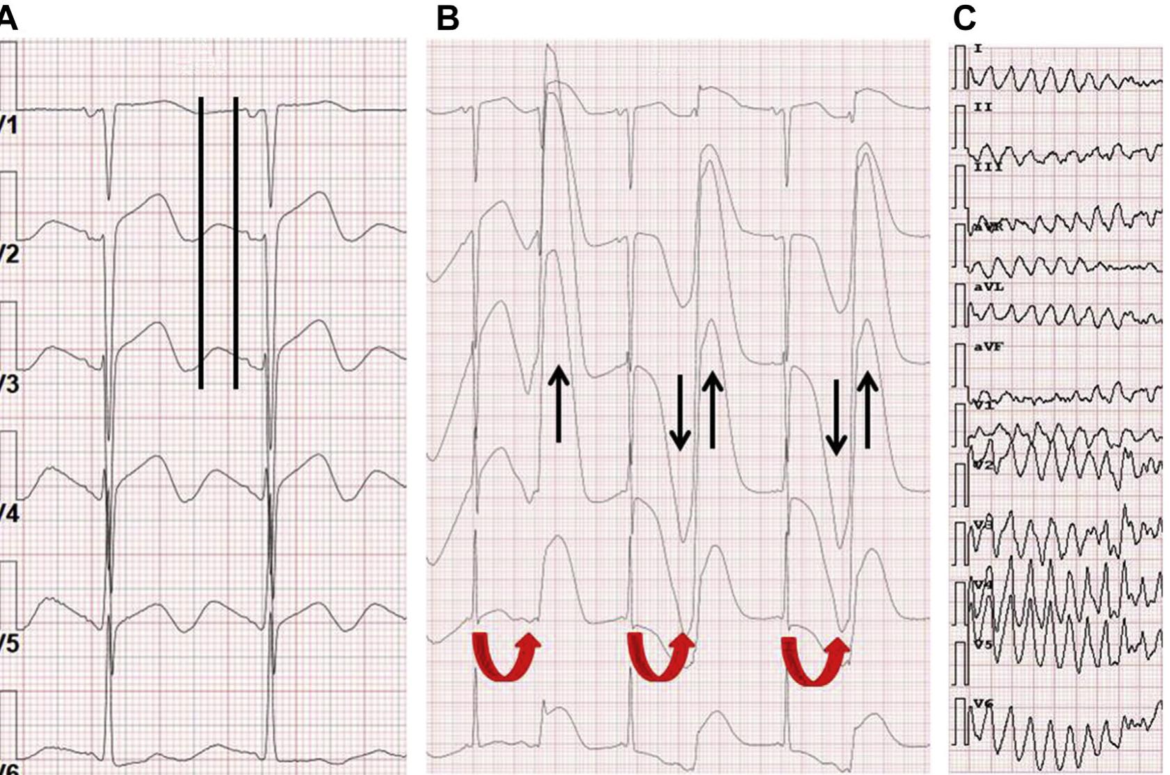 Tricular (PDF) Normal Ventricular Repolarization and QT Interval