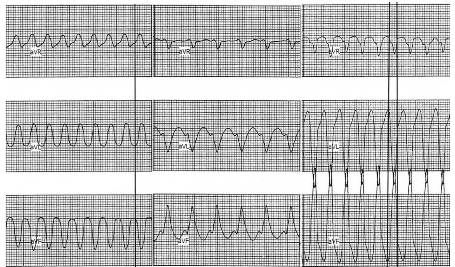 (PDF) New algorithm using only lead aVR for differential diagnosis of ...