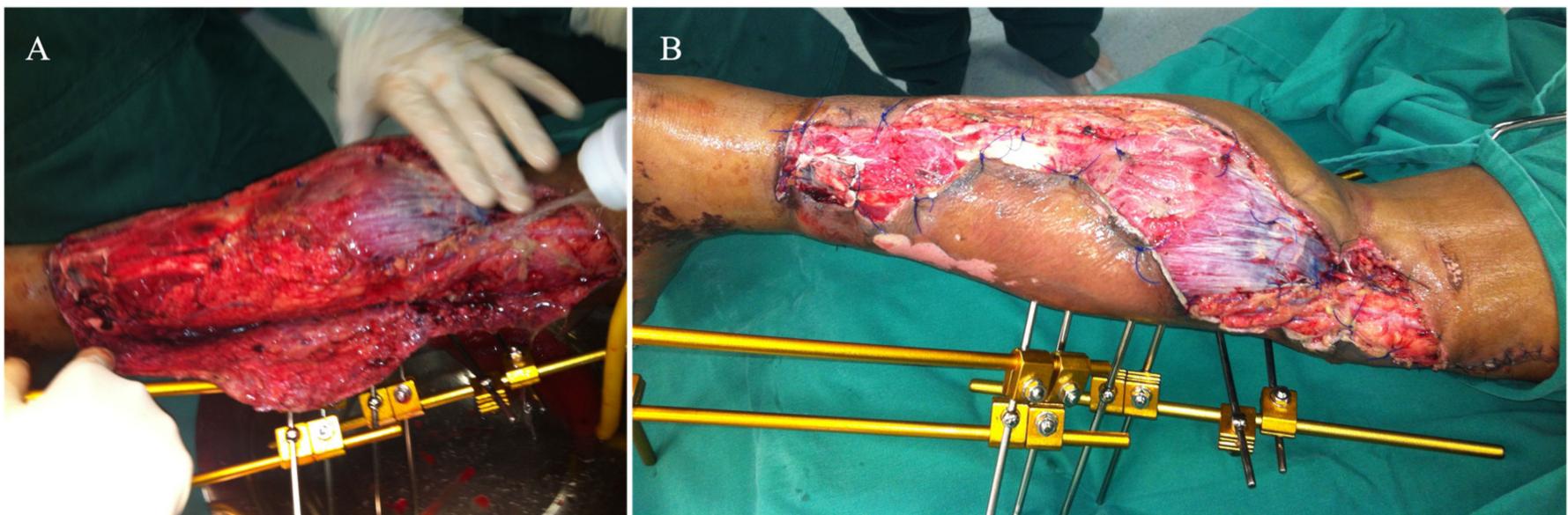 Debrided (a,b) anterior and medial aspects of the left leg on day 2,