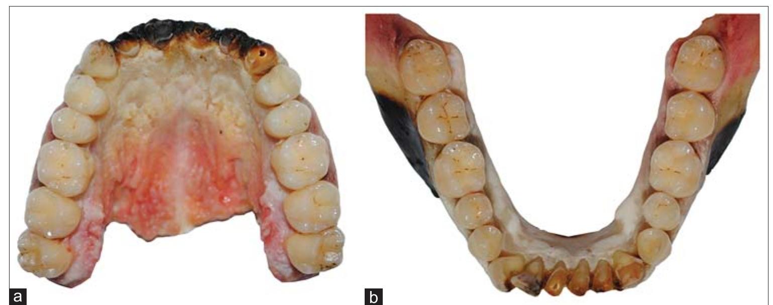 Occlusal view of maxilla (a) and mandible (b) after