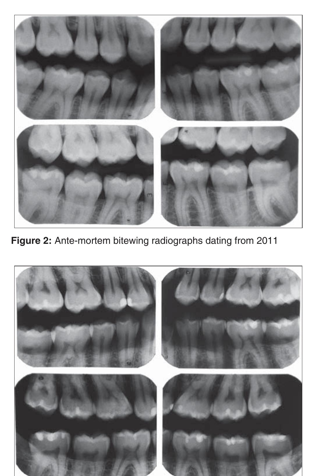 (PDF) Dental human identification using bitewing radiographs - a case ...