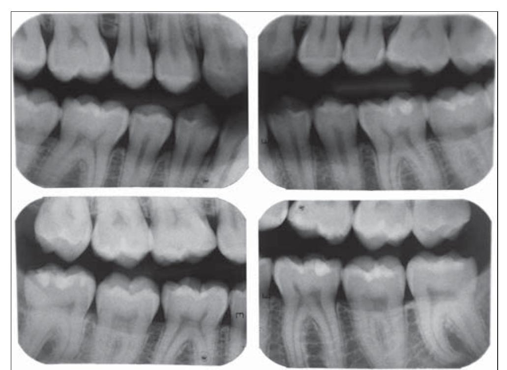 (PDF) Dental human identification using bitewing radiographs - a case ...