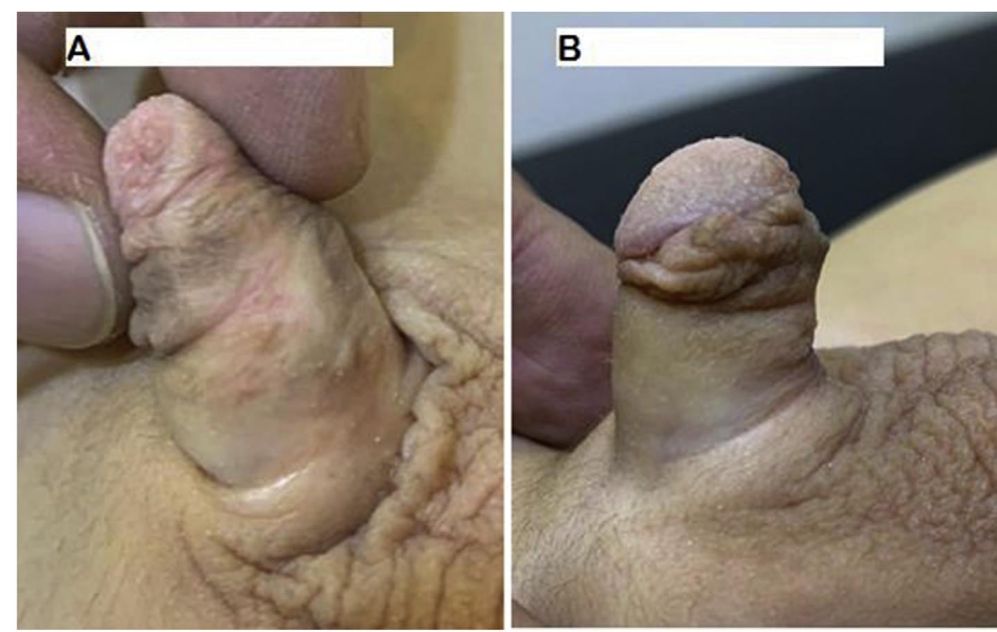 (PDF) Five years’ experience of double faced tubularized preputial flap ...