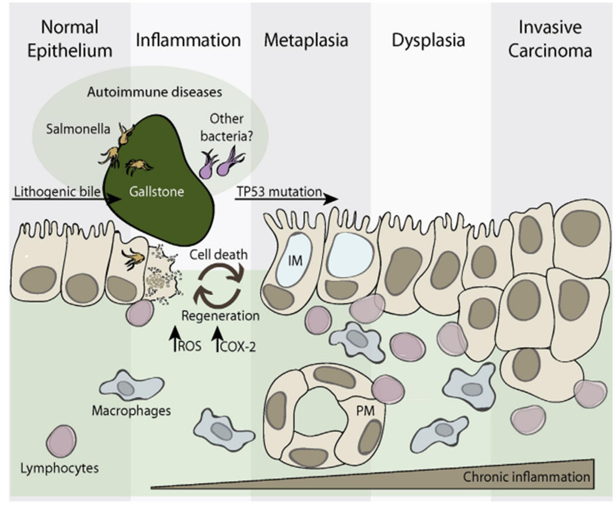 Figure 2 - The inflammatory inception of gallbladder cancer