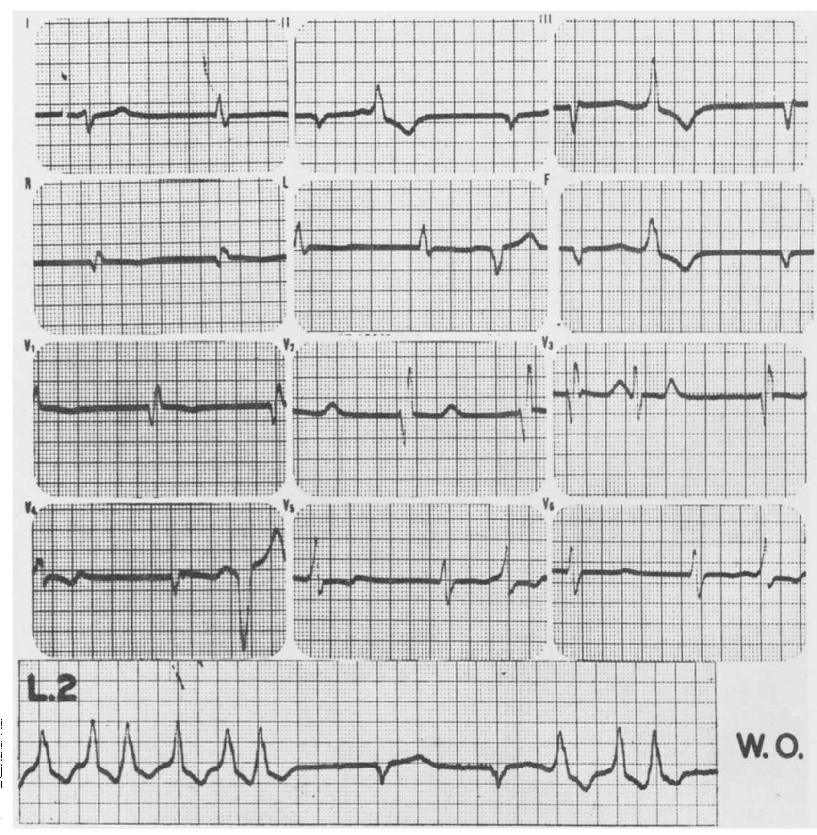 Top: twelve lead electrocardiogram demonstrating slow nodal