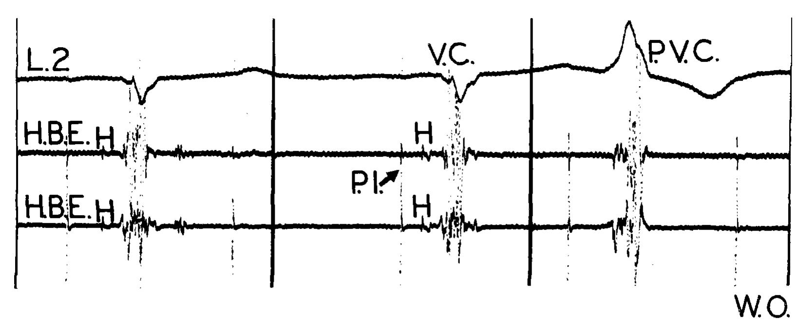Pvc Electrogram No spontaneous atrial activity or response to atrial