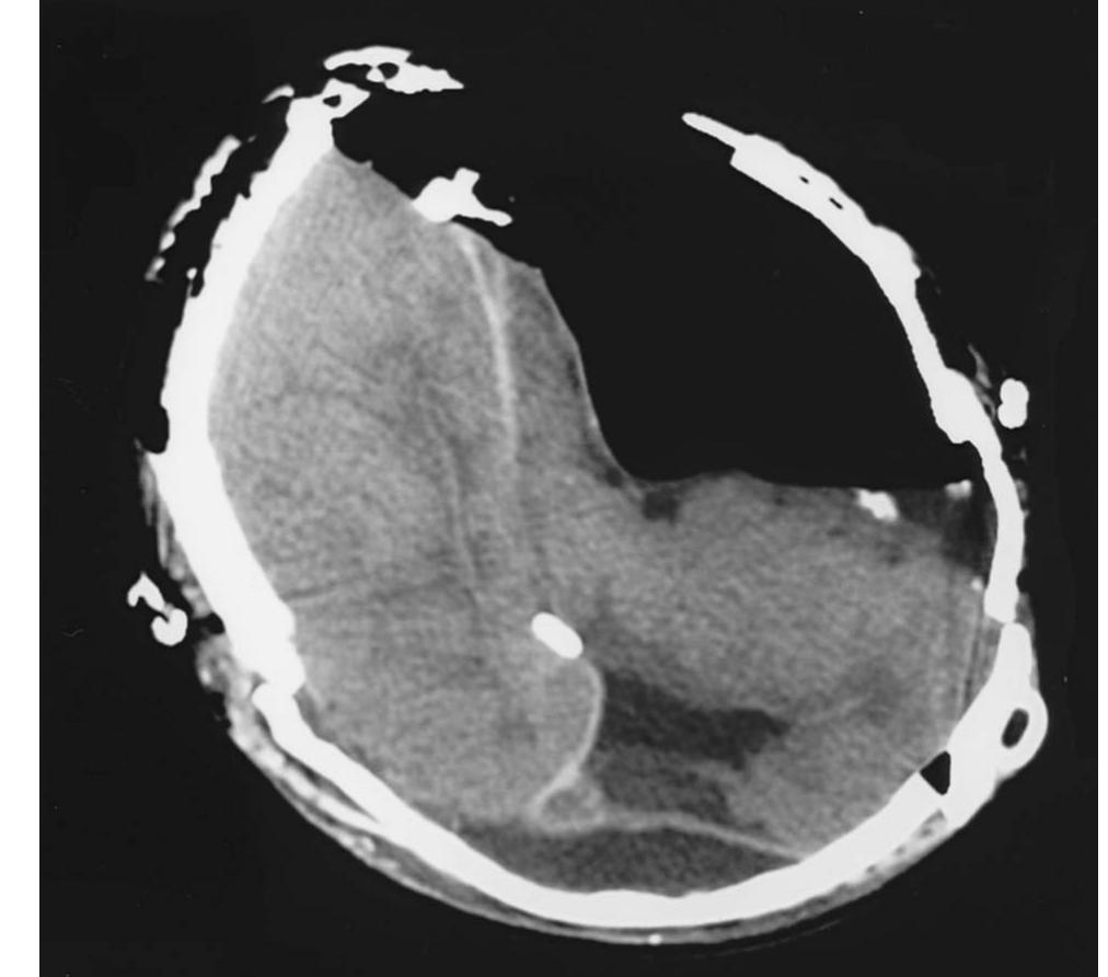 Postoperative axial computed tomography scan showing tension