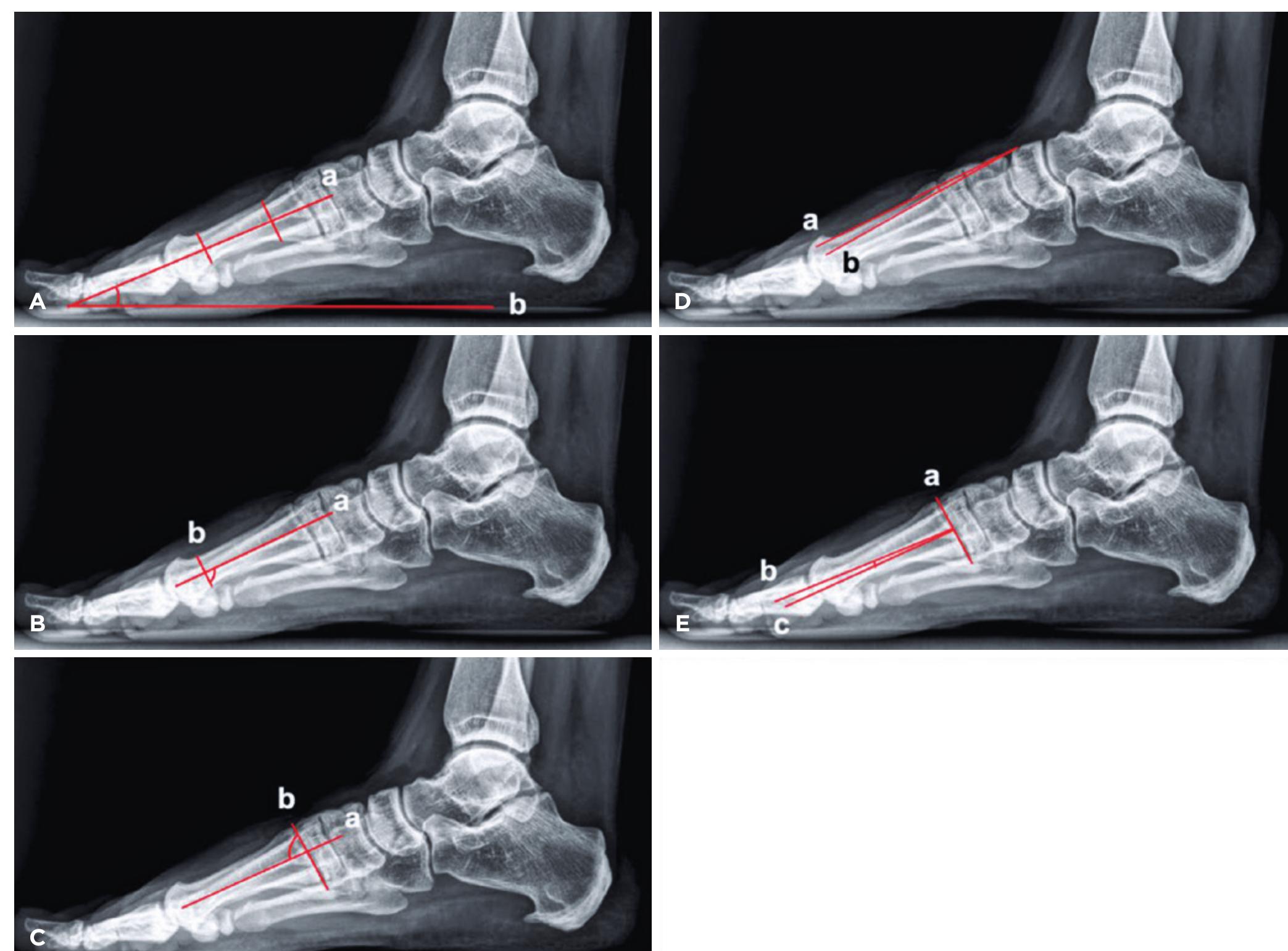 Measuring Dmaa (PDF) Inter- and intraobserver reliability of the first metatarsal ...