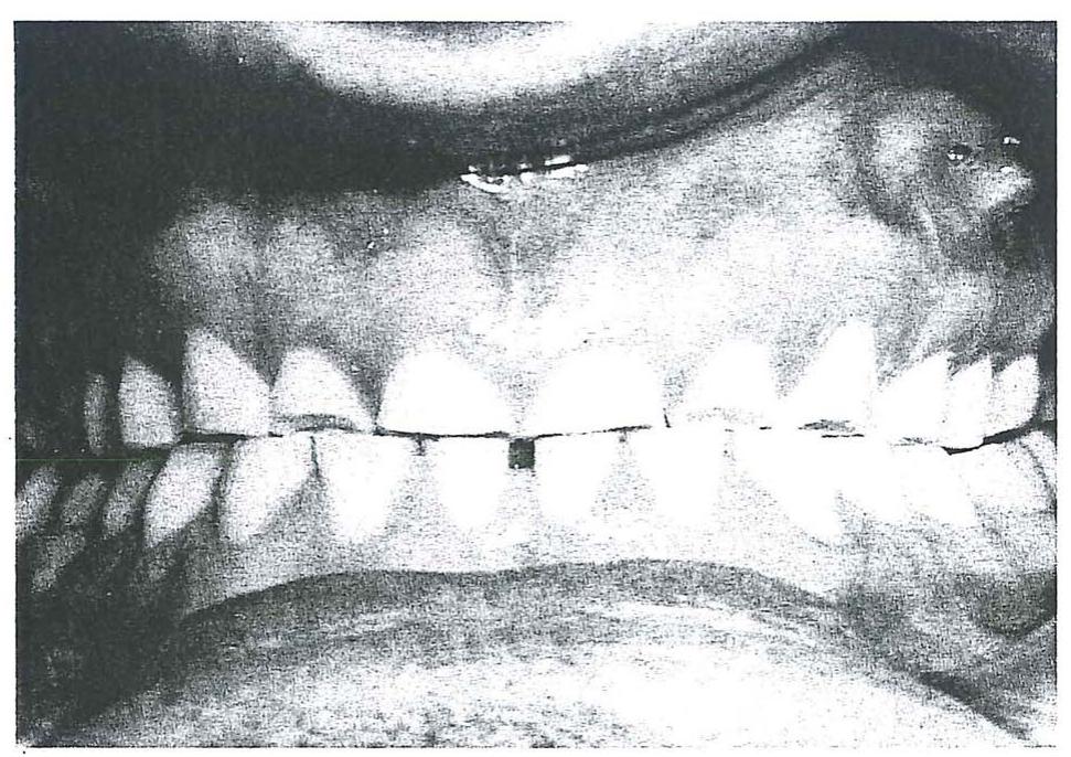 (PDF) Tooth Wear: Use of Overlays with Metallic Structures