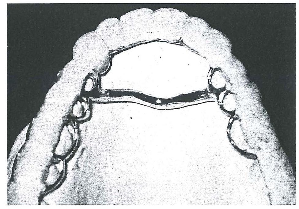 (PDF) Tooth Wear: Use of Overlays with Metallic Structures