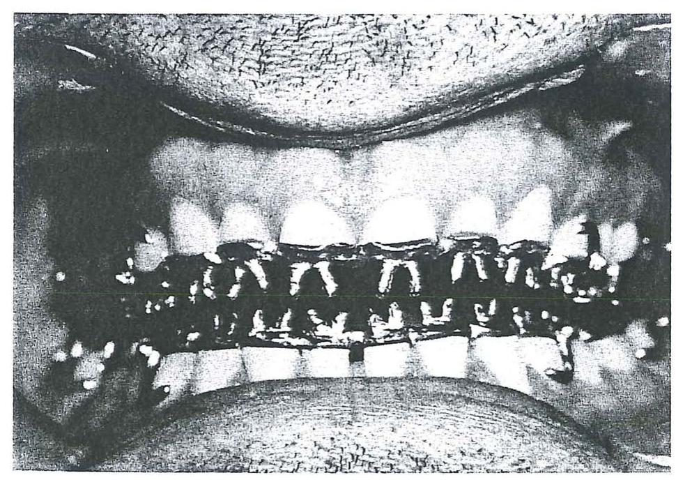 (PDF) Tooth Wear: Use of Overlays with Metallic Structures