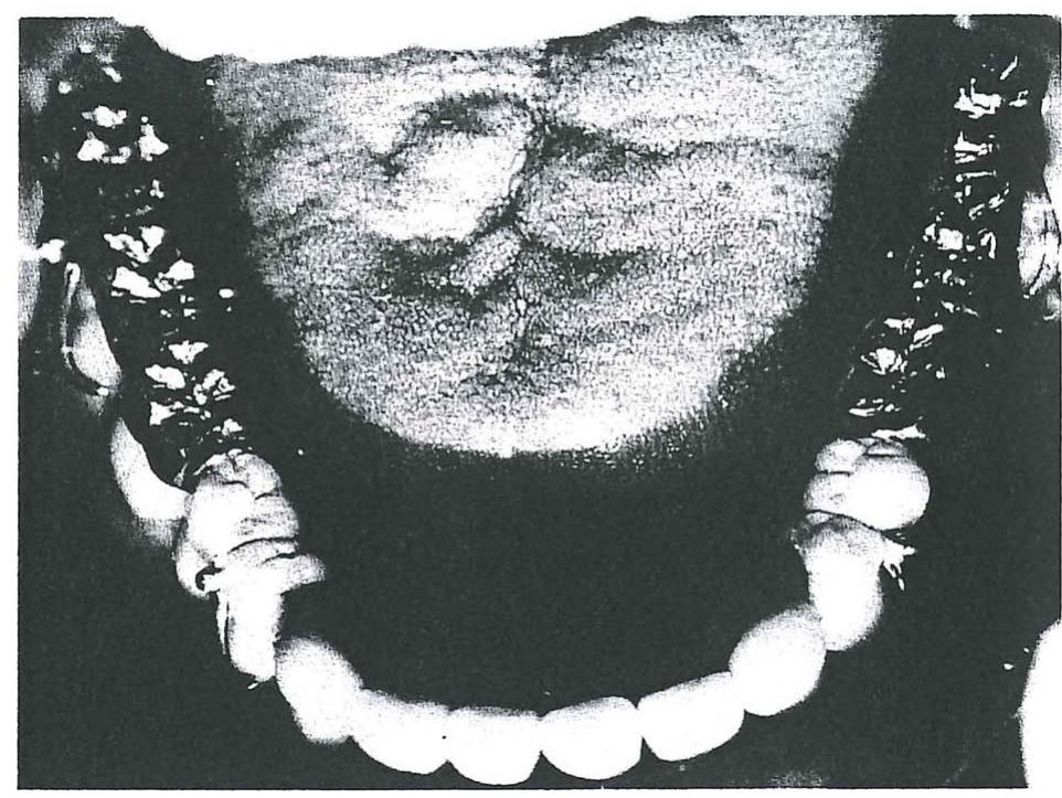 Figure 8 - from Tooth Wear: Use of Overlays with Metallic