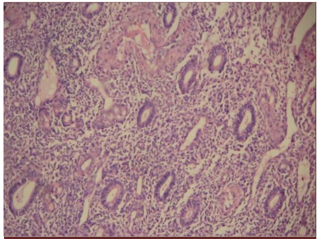 (PDF) Histopathological interpretation of endometrium in abnormal ...