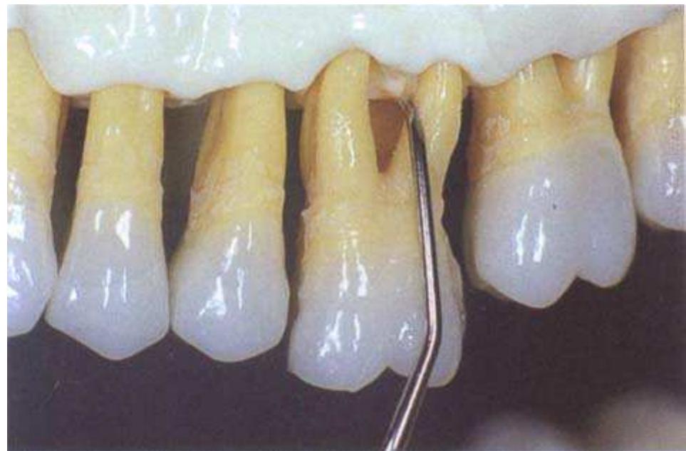 Mini five 11-12 curet adapted to the mesial surface of the