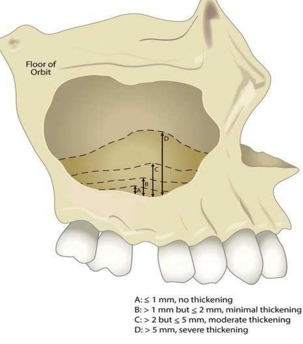 Figure 2 - Perforation of the maxillary sinus in implant