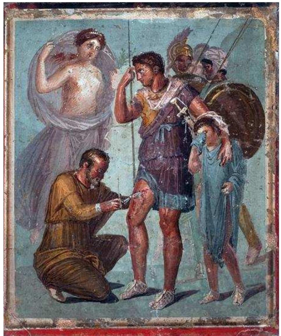 Figure 2. Field surgeon Iapyx in his professional garment, kneeling, carefully carries out the surgical process aiming to remove the dangerously embedded arrowhead from the right thigh of Aeneas. The latter, standing patiently in a heroic posture, showing no fear, no pain, embracing and thus encouraging his crying son Ascanius, averts part of the upper body weight from his wounded leg resting and seeking auxiliary stability on his long spear. His mother Aphrodite (Venus), just reaching the scene from Crete, unveiled at that moment, with agony in her eyes for her son’s wellbeing, brings dittany she holds in her left hand, part of the potent medicine for the miraculous extraction of the arrowhead. In the background nervous but with determination Trojan warriors pace under arms, confidants to Aeneas. The one closest to Aeneas instead of the protection offered by the helmet wears only a type of under-helmet “felt cap”, indicative of their interim distance from battle action with Aeneas’ traumatism (source: Wikipedia Commons). 