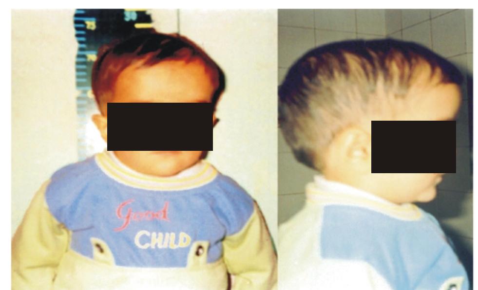 pdf-laron-syndrome-a-case-report