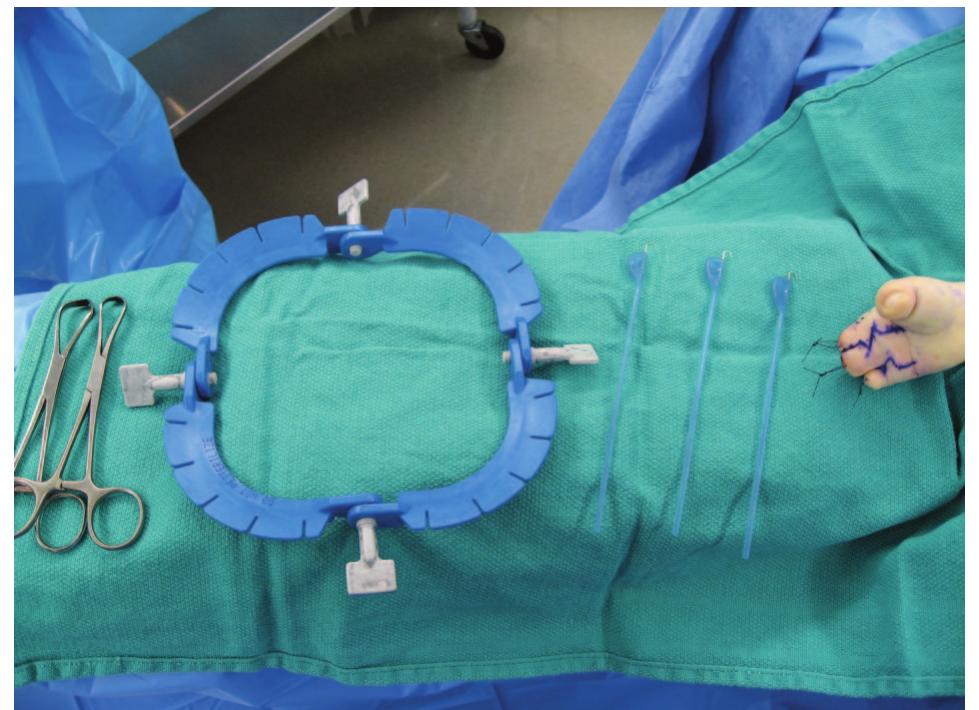 Retractor Clips Figure 21 - from Brain Plasticity after Unilateral