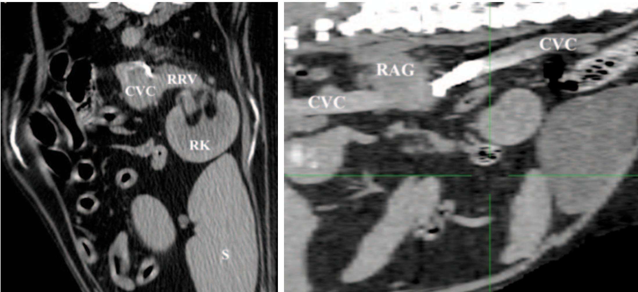 (PDF) Adrenal neoplasia in dogs: clinical and surgical approach