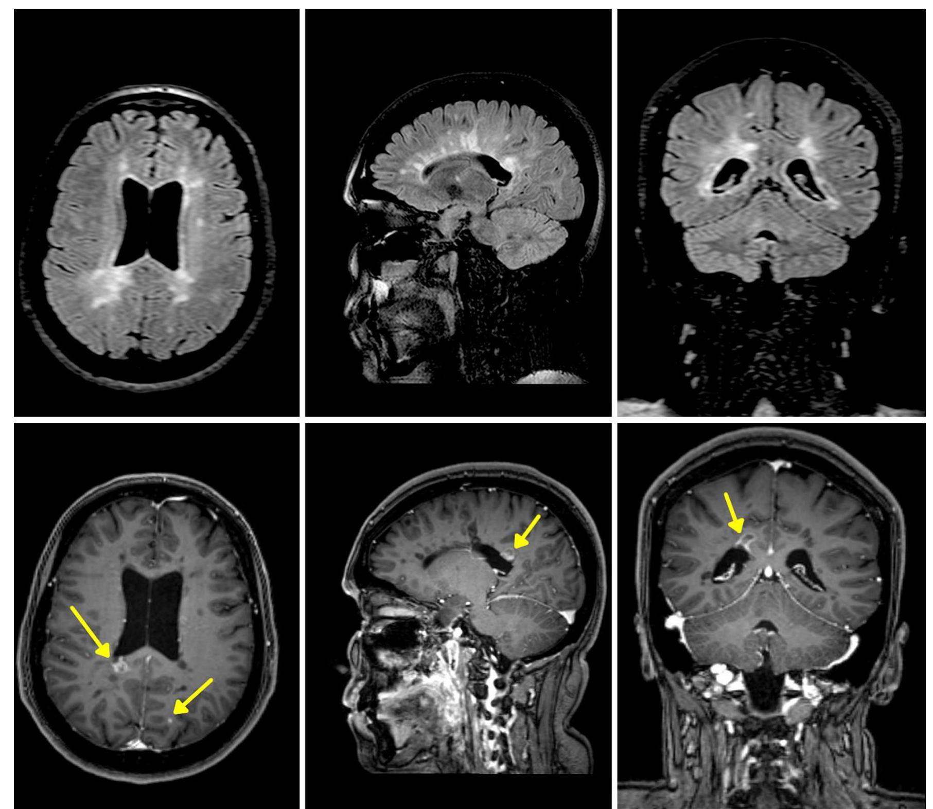 Axial, sagittal and coronal mri slices (3 tesla, philips
