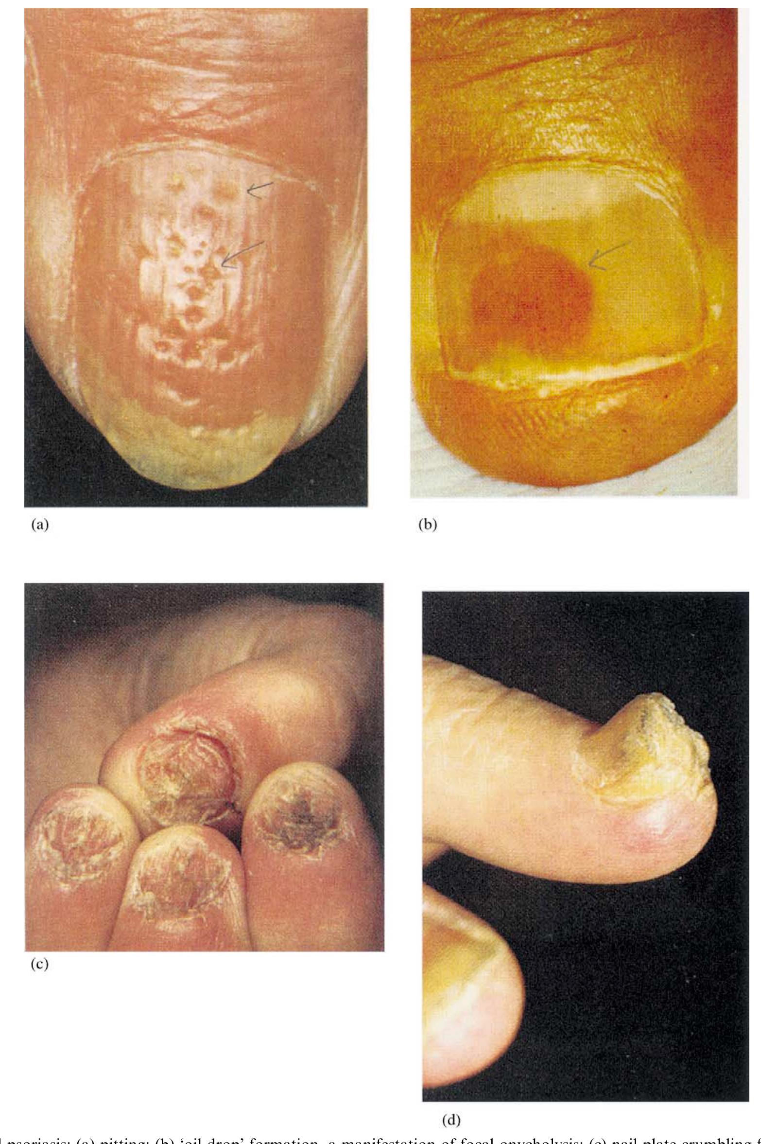Cortexed Nail Figure 1 - from Drug delivery to the nail following topical