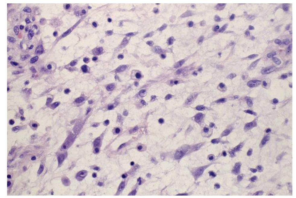 Pleomorphic Rms (PDF) Orbital rhabdomyosarcomas: A review