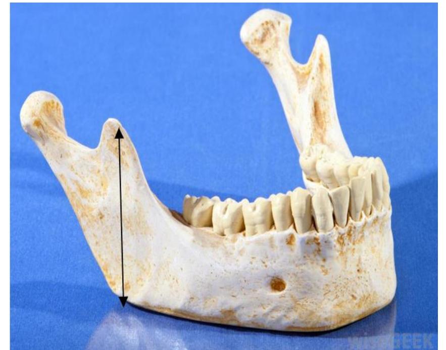 (PDF) Size of coronoid process and ramus as novel parameters in ...