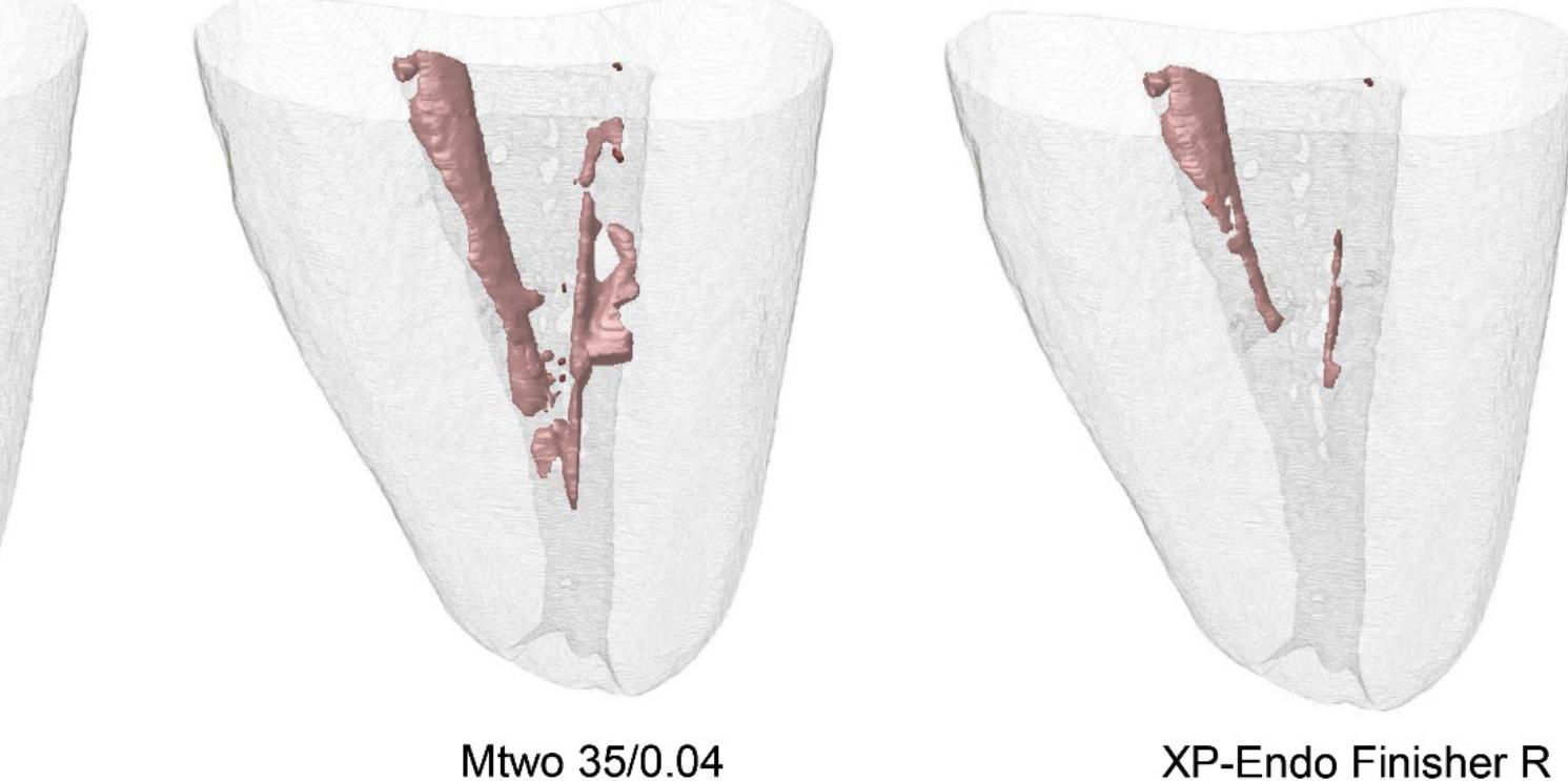 Root R Scan Body (PDF) Removal of the Previous Root Canal Filling Material for ...