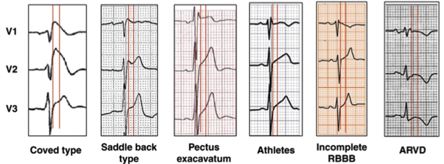 (PDF) Brugada ECG patterns in athletes