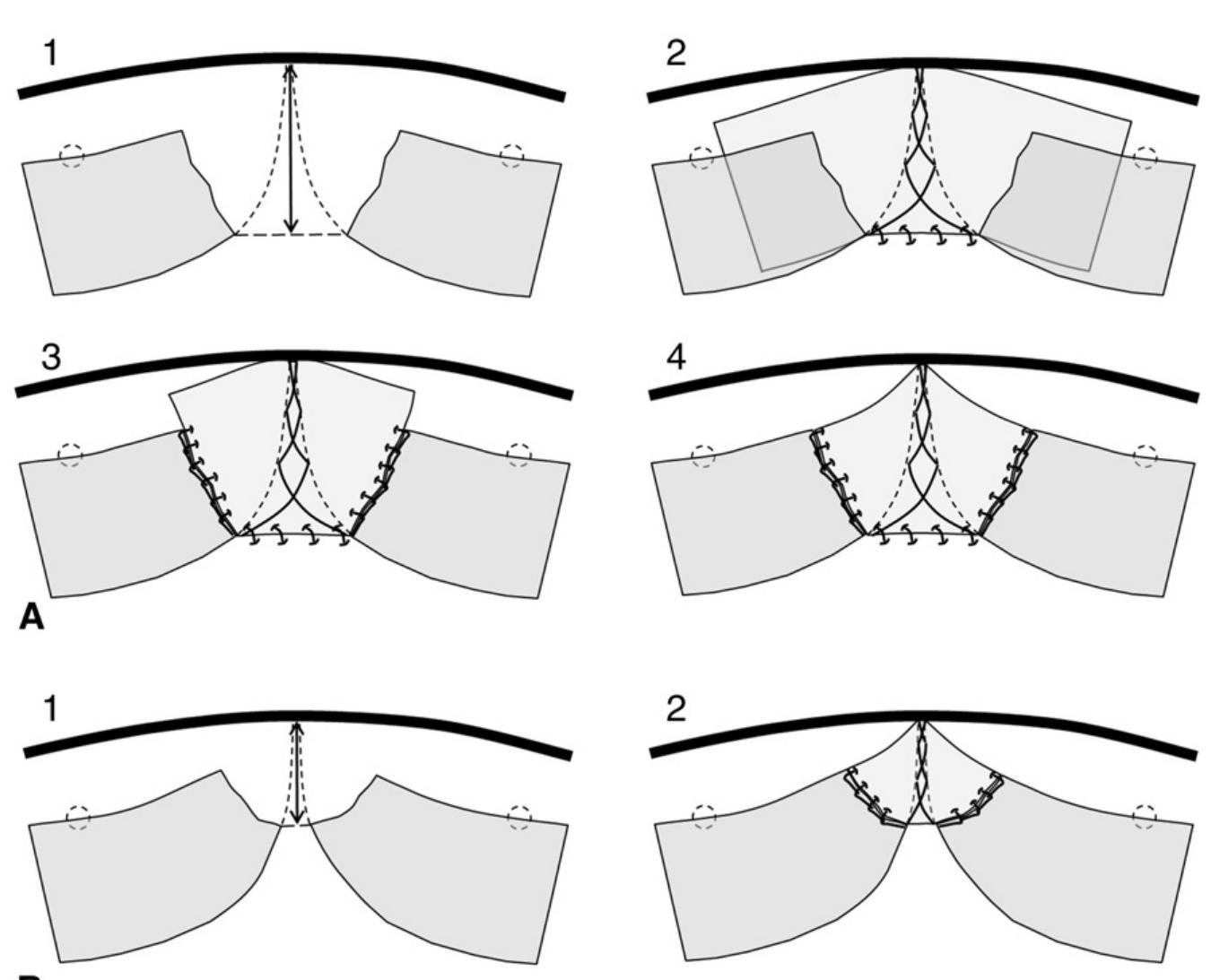 (PDF) A simple technique of commissural reconstruction in aortic valve ...