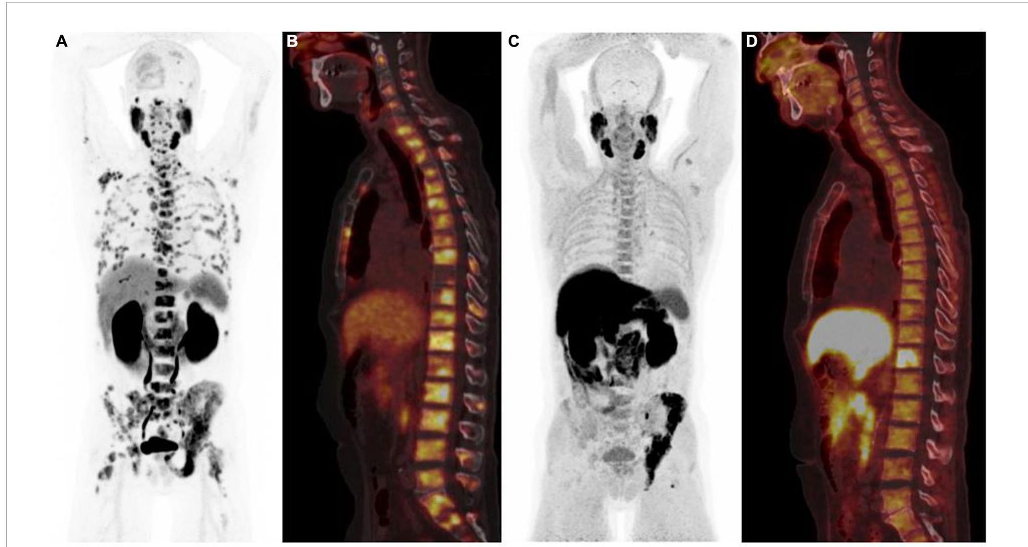 (PDF) Nuclear medicine imaging for bone metastases assessment: what ...