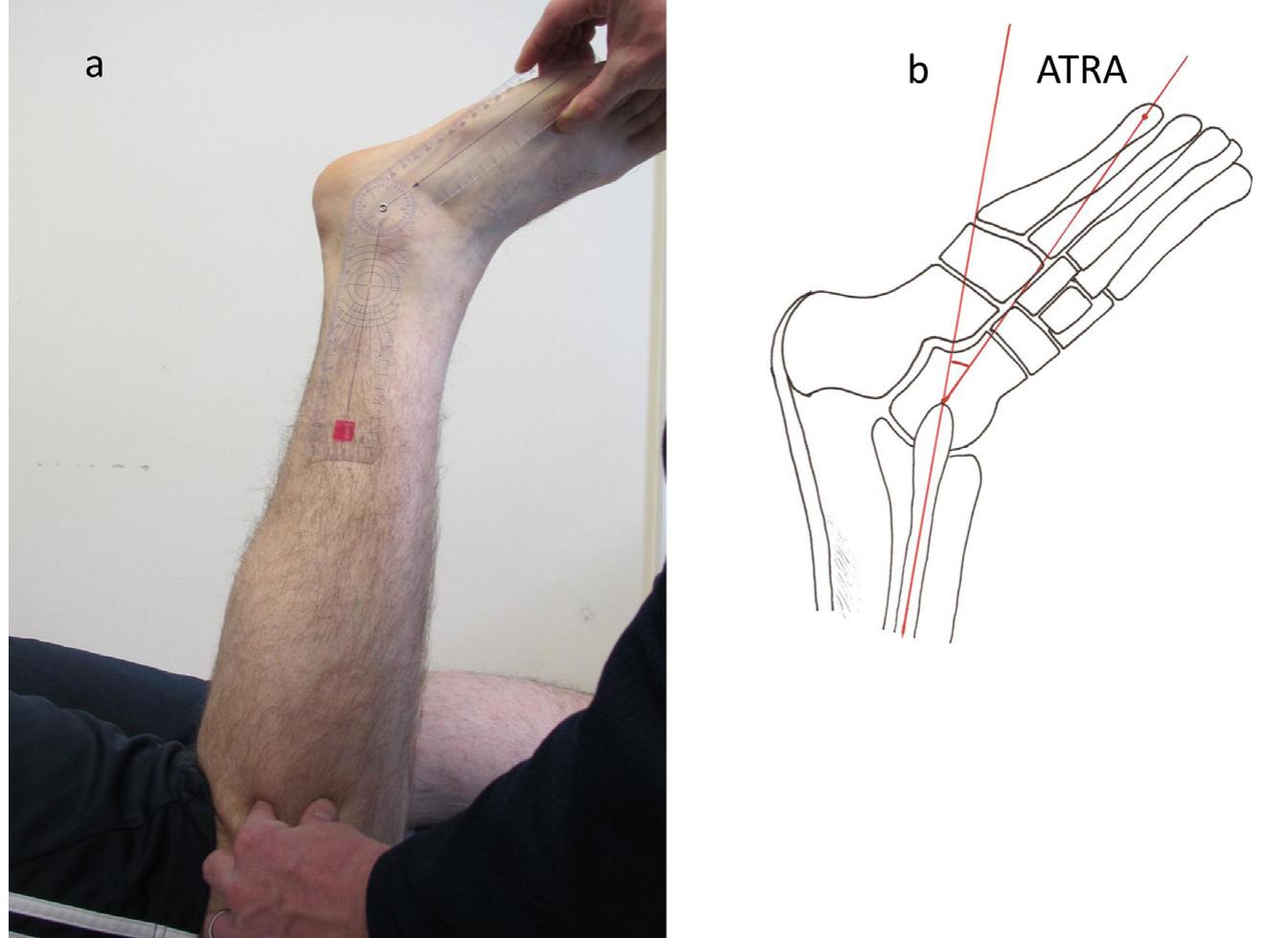 pdf-reliability-of-achilles-tendon-resting-angle-and-calf