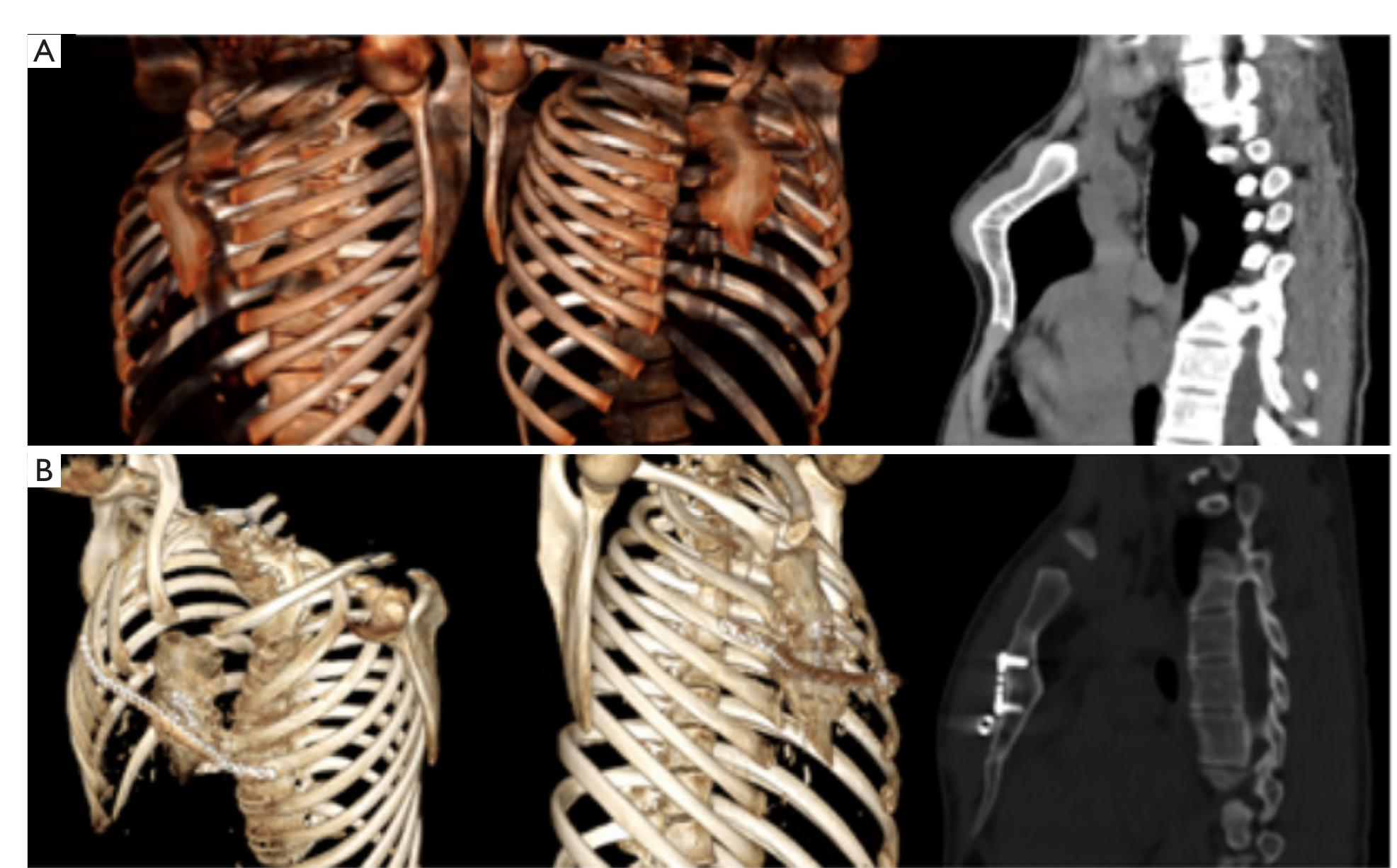 Preoperative ct-scan. sagittal (a), coronal (b) and axial