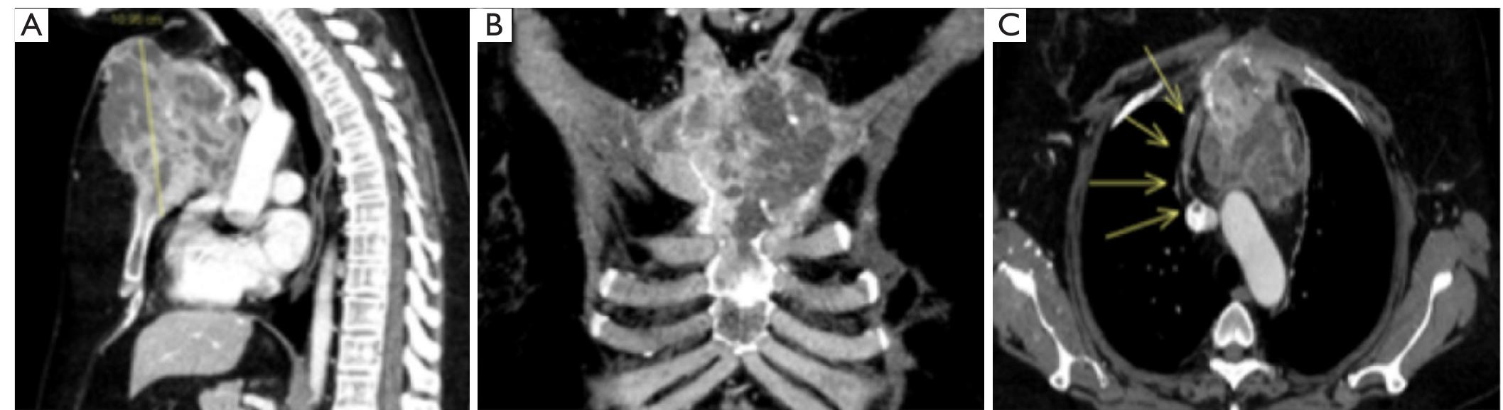 Preoperative ct-scan. sagittal (a), coronal (b) and axial